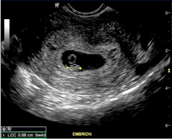 Ultrasonido obstétrico endovaginal